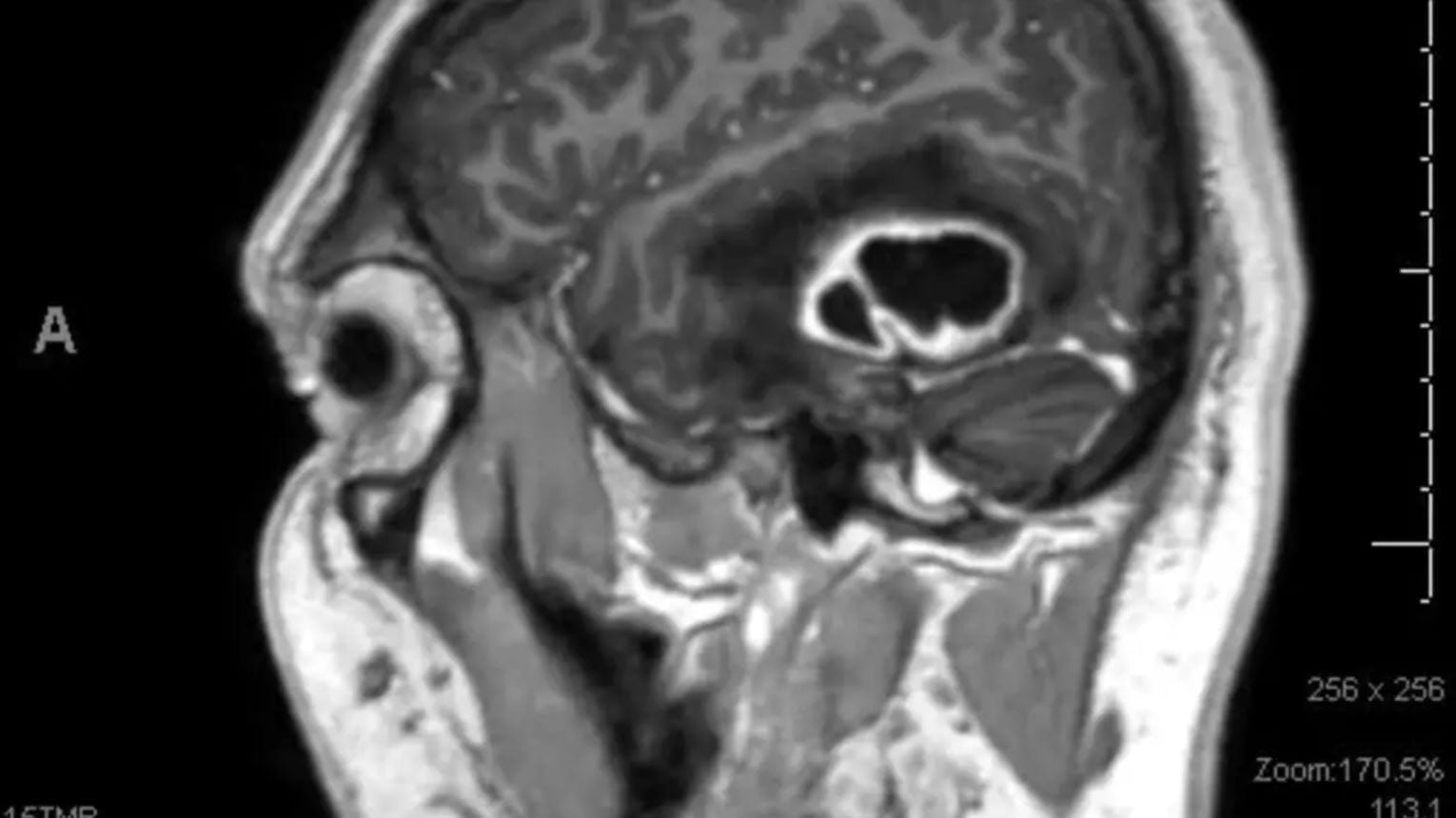 New MRI techniques mean fewer brain surgeries like the one that removed this apple-sized abscess