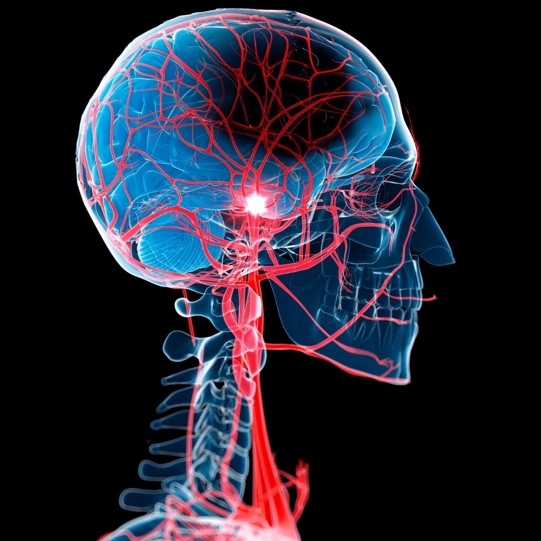 No relationship found between DW-MRI lesions and long-term stroke risk following carotid revascularisation